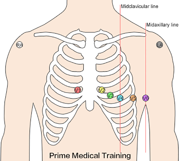 pediatric ecg lead placement